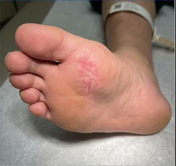 After Treatment